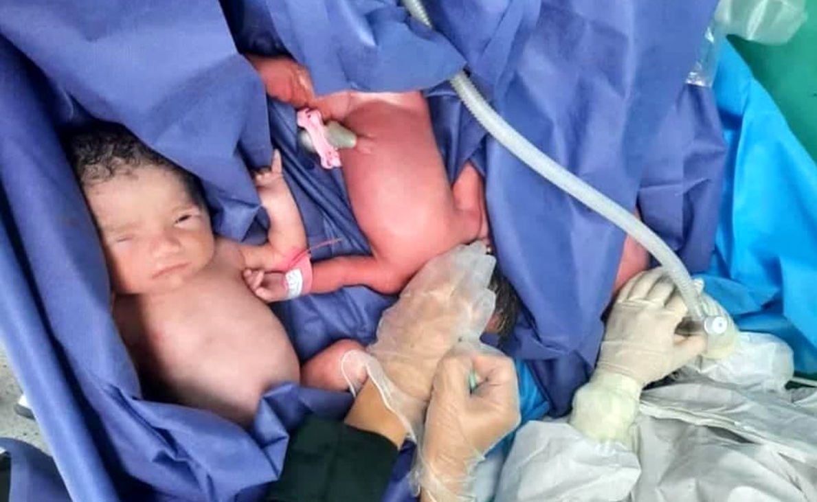 مادرکرونایی در بیمارستان امام رضا(ع) 3 قلو به دنیا آورد